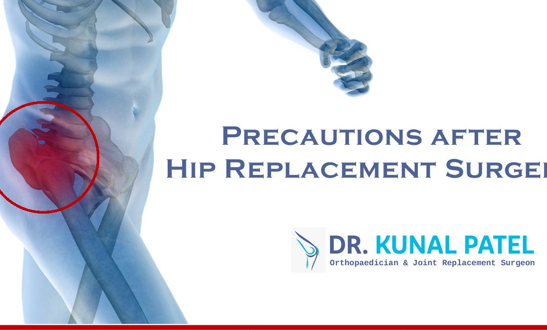 Precautions after Hip Replacement Surgery
